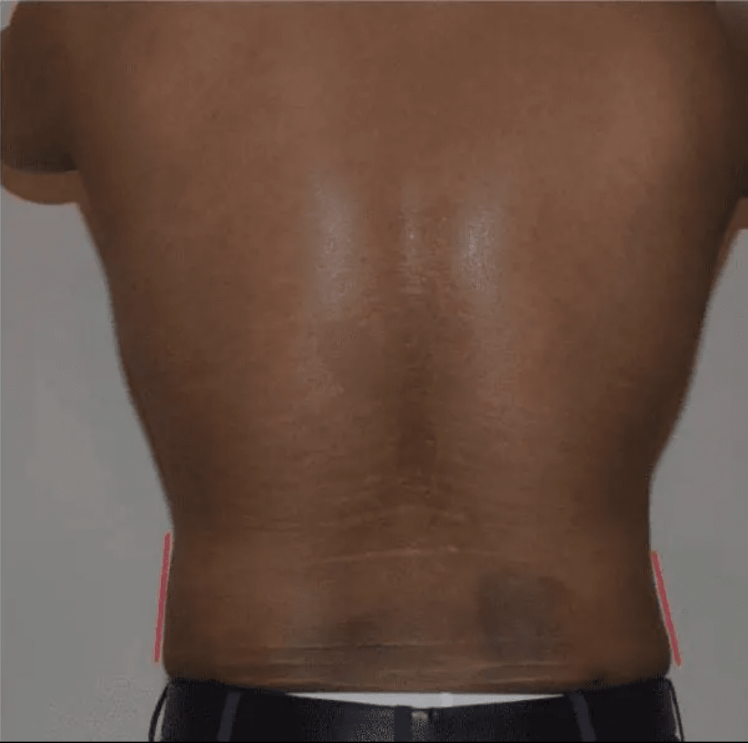 Liposuction After, undefined undefined - 4115