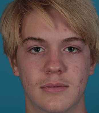 Acne Treatment After, undefined undefined - 4141