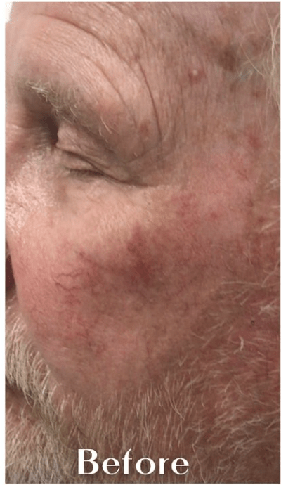 Vein Treatment Before, undefined undefined - 4245