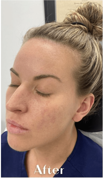 Birthmark Removal After, undefined undefined - 4246