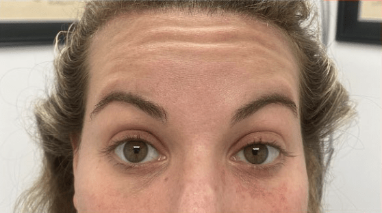 Botox Before, undefined undefined - 4250