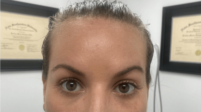 Botox After, undefined undefined - 4250
