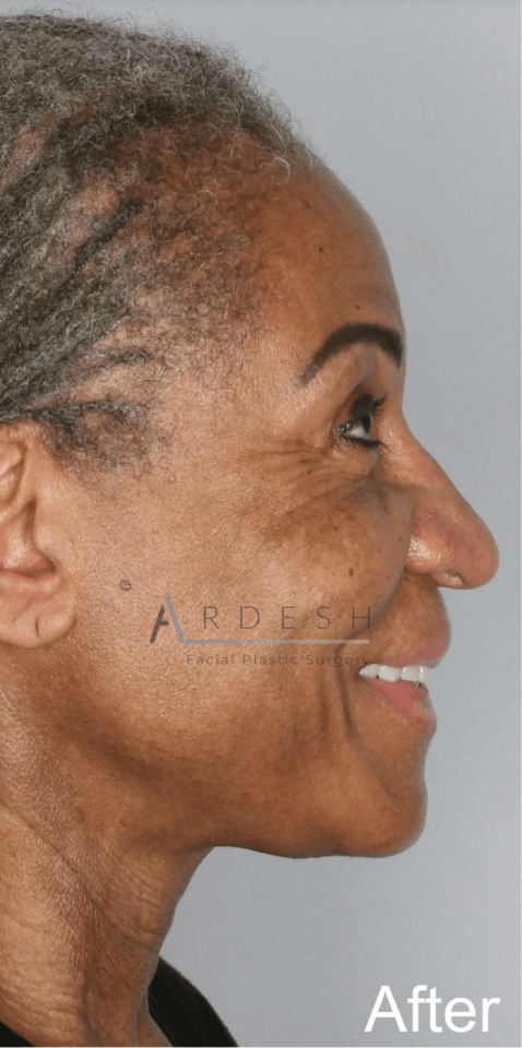 Facelift After, undefined undefined - 4262
