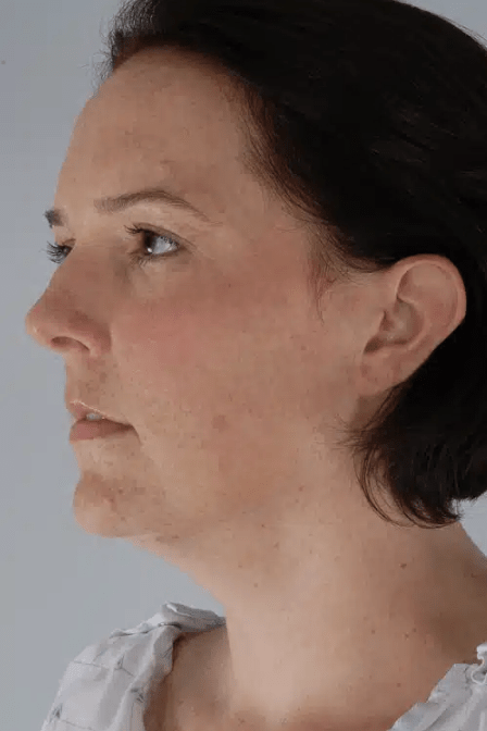 Neck & Jawline Definition Solutions Before, undefined undefined - 4321