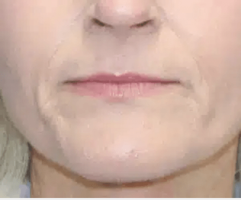 Lip Lift Before, undefined undefined - 4328