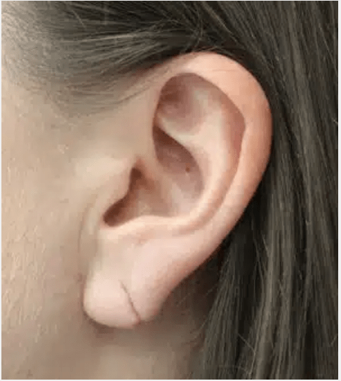 Earlobe Surgery Before, undefined undefined - 4331