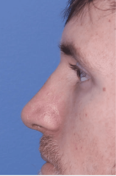 Rhinoplasty After, undefined undefined - 4337