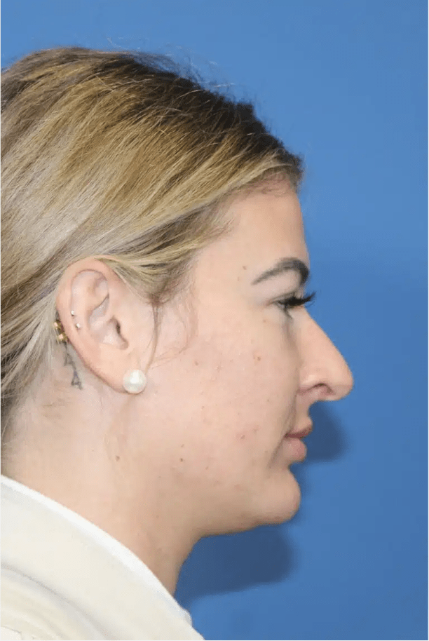 Rhinoplasty Before, undefined undefined - 4342