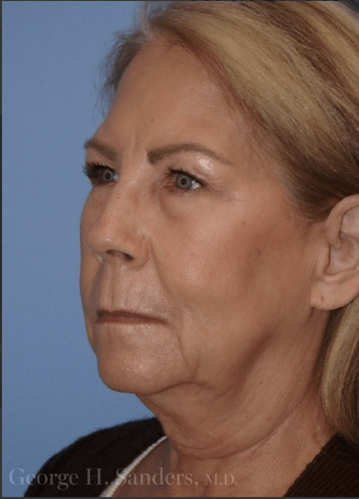 Facelift Before, undefined undefined - 4373