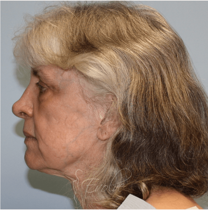 Neck Lift Before, undefined undefined - 4461