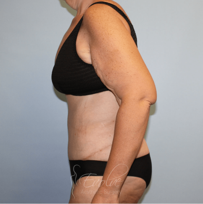Tummy Tuck (Abdominoplasty) After, undefined undefined - 4486