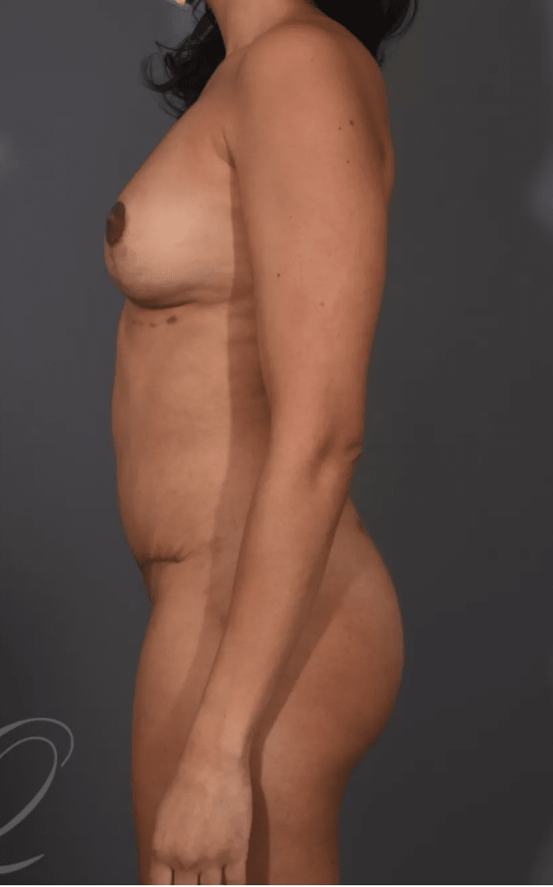 Breast Augmentation with Fat Transfer After, undefined undefined - 4535