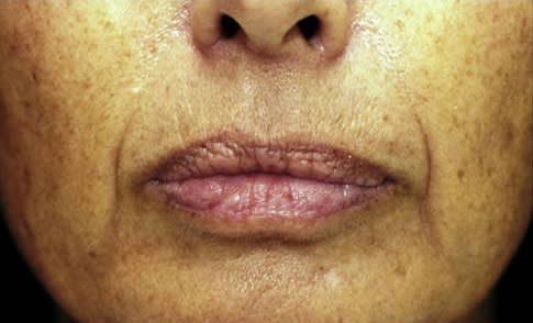 Sculptra® Before, undefined undefined - 2032