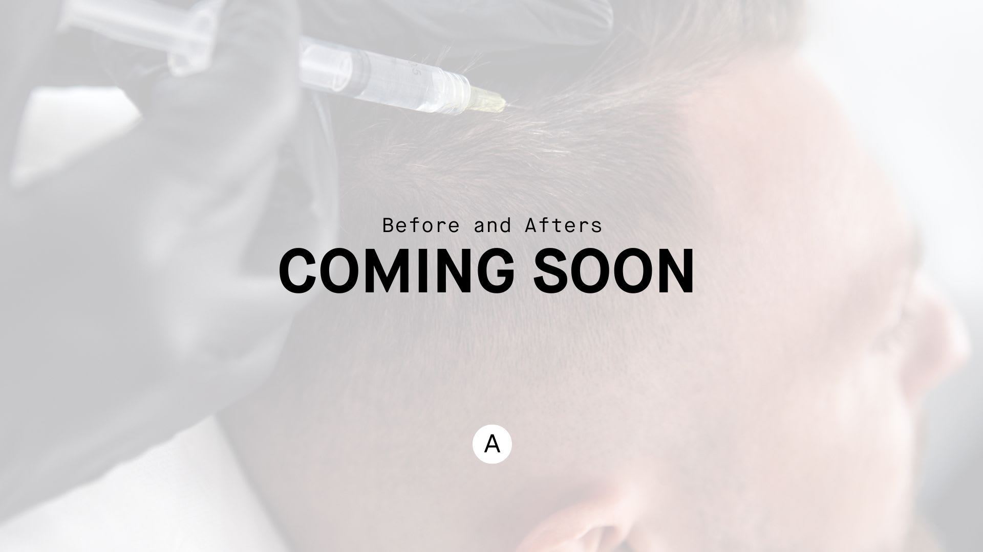 PRP Hair and Skin Therapy After, undefined undefined - 4905