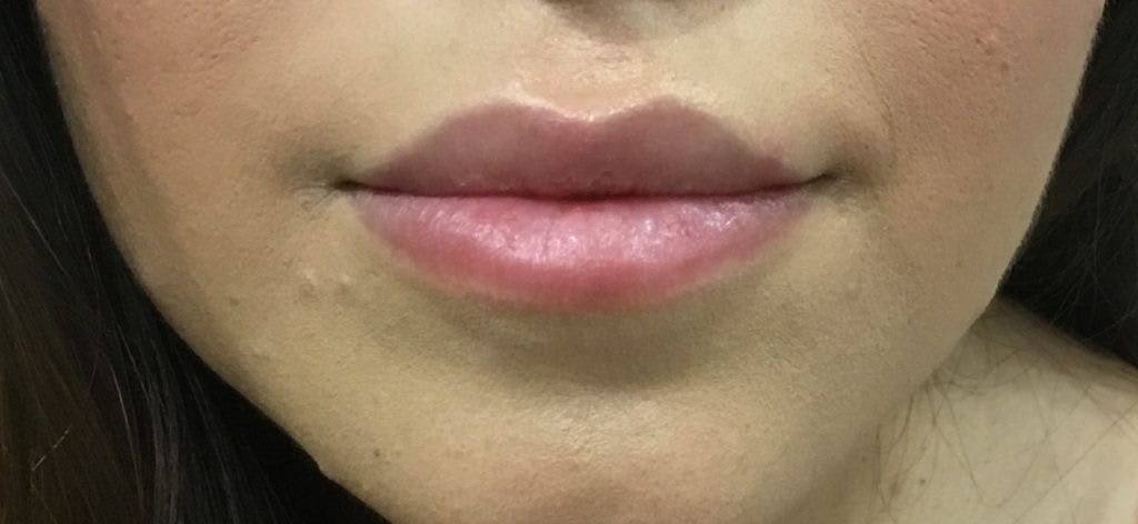 Dermal Fillers & Injectables Before, undefined undefined - 1316