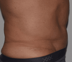 Abdominoplasty After, undefined undefined - 267
