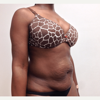 Tummy Tuck (Abdominoplasty) Before, undefined undefined - 2058