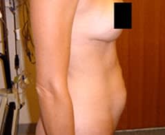 Abdominoplasty Before, undefined undefined - 1076