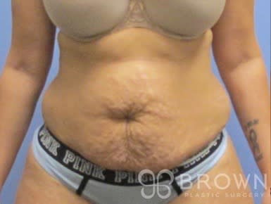 Tummy Tuck (Abdominoplasty) Before, undefined undefined - 3152