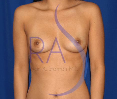 Breast Augmentation with Implants Before, undefined undefined - 466
