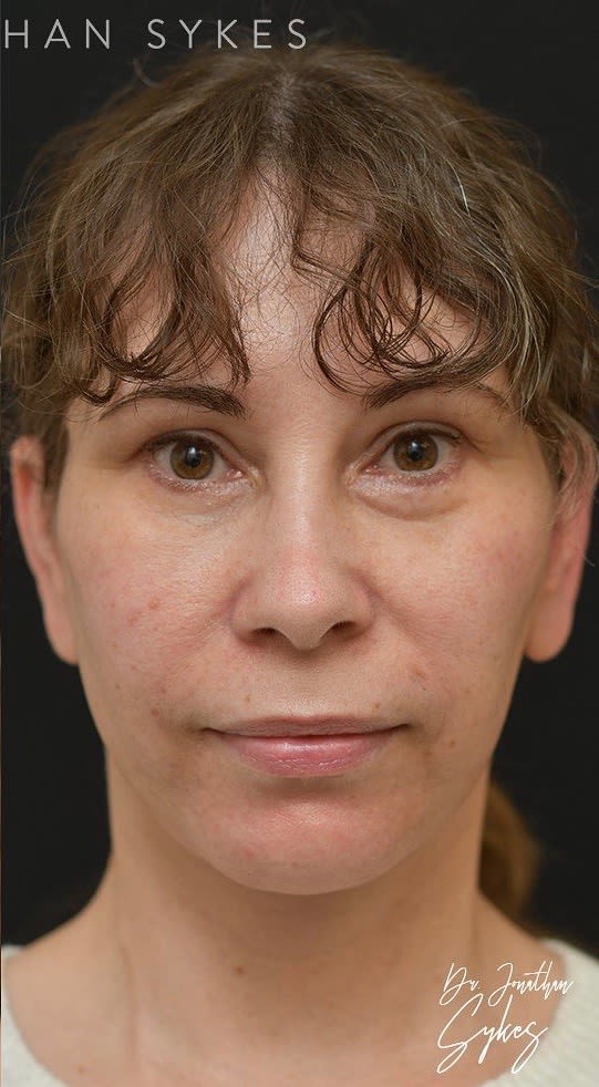 Upper Eyelid Blepharoplasty After, undefined undefined - 2249