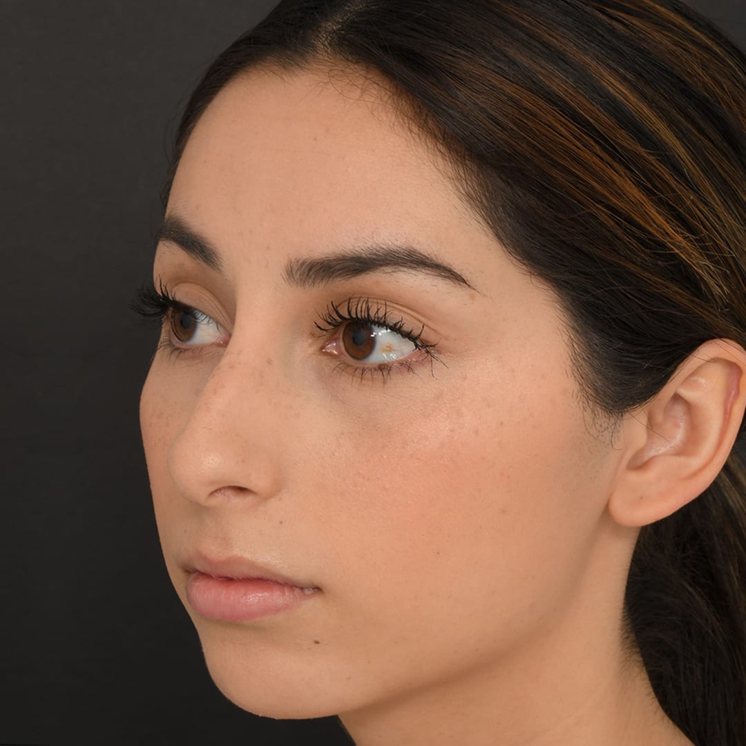 Rhinoplasty Before, undefined undefined - 59