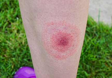 A circular rash associated with lyme disease
