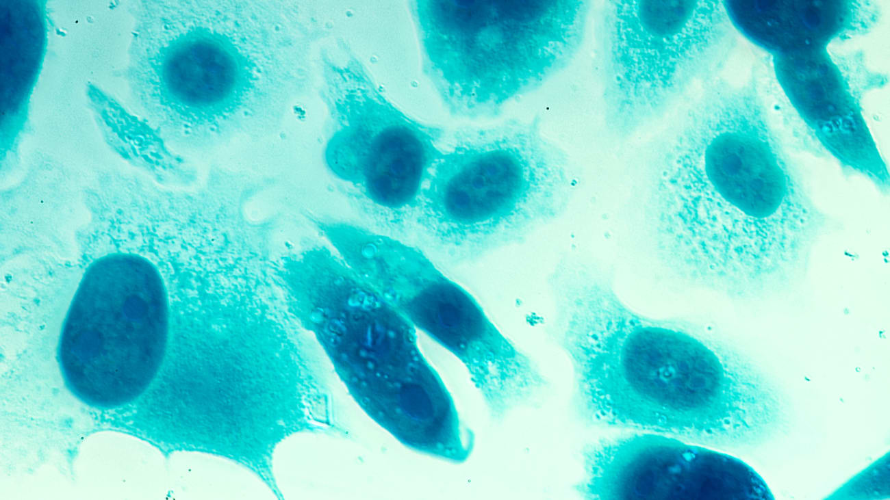 prostate cancer