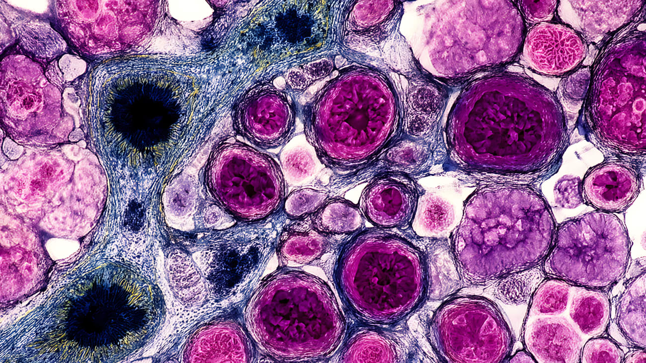 pancreatic cancer
