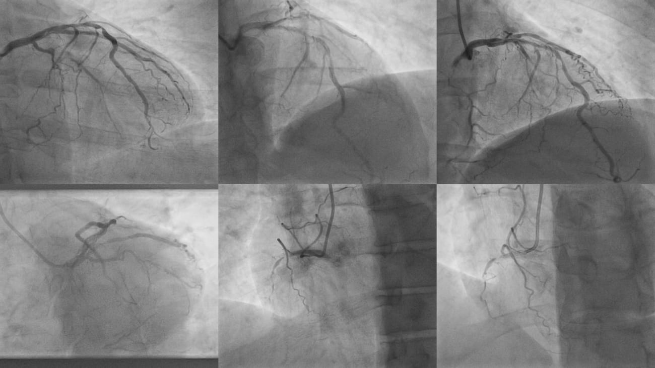 coronary artery disease