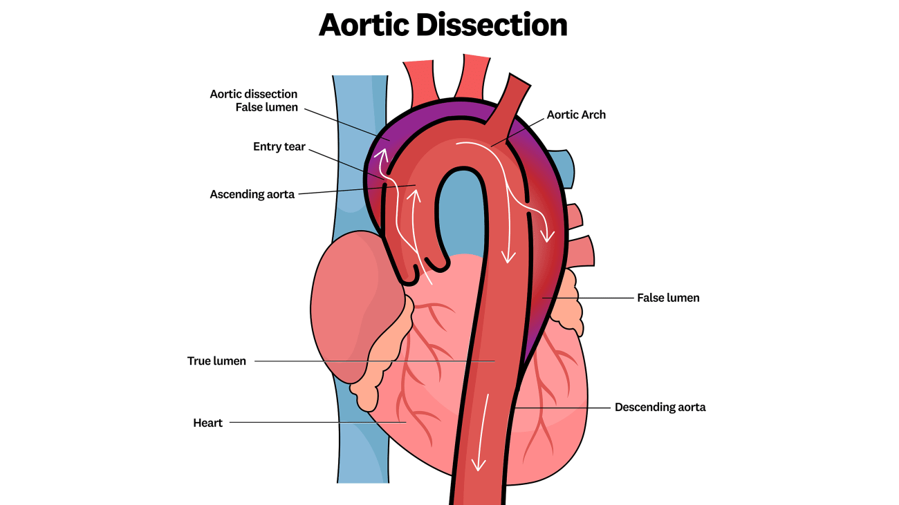 AorticDissectionEdited_canvas copy