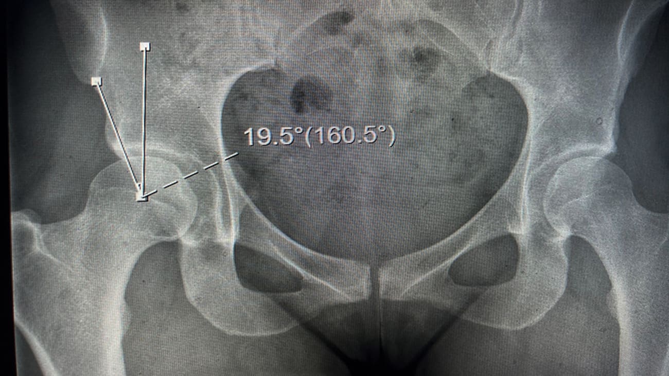 Figure 1: Dysplasia in a young woman manifesting as a lateral center edge angle <20°; note the shallow, bowl-shaped acetabulum.