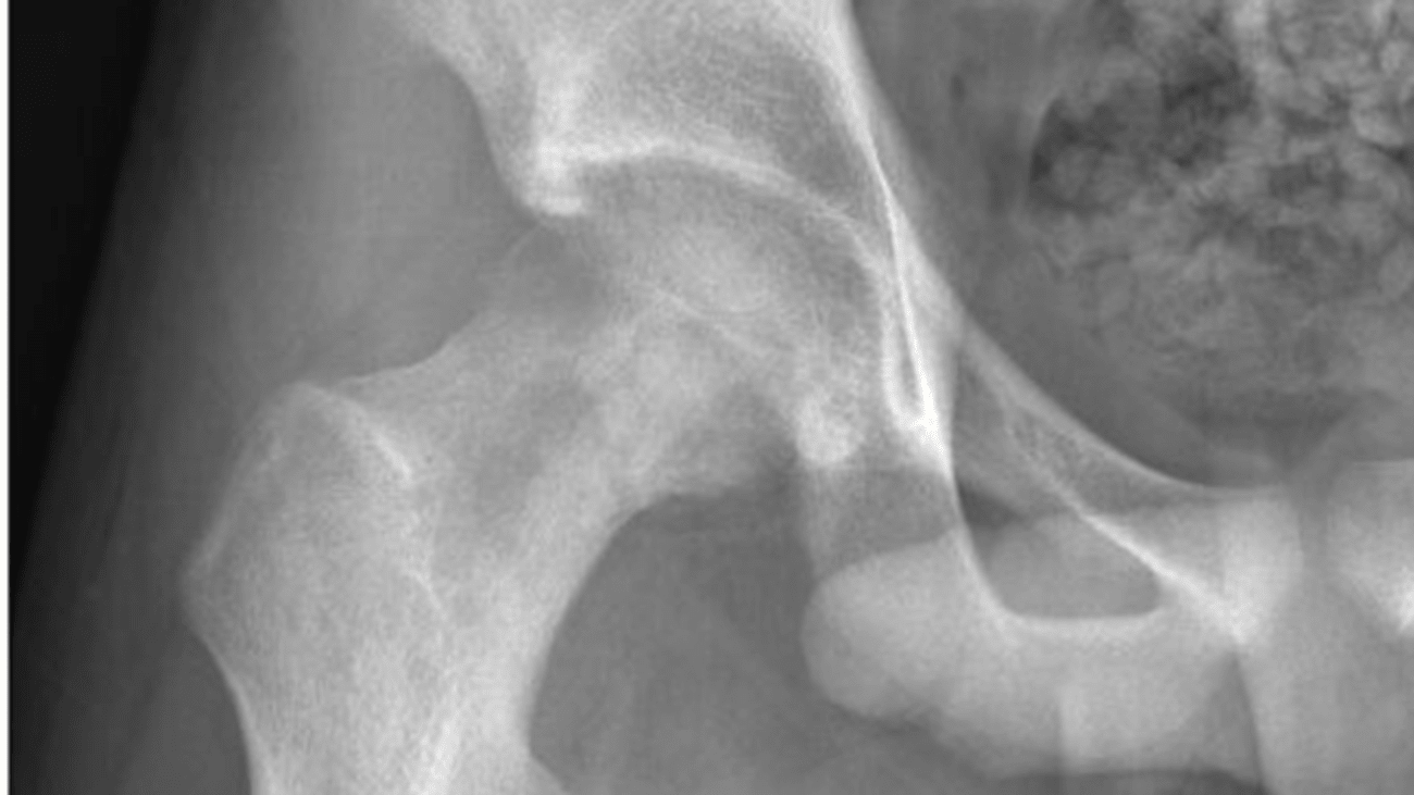 Fig1_cropped Figure 1: Radiograph of the right proximal femur showing high-grade osteosarcoma.