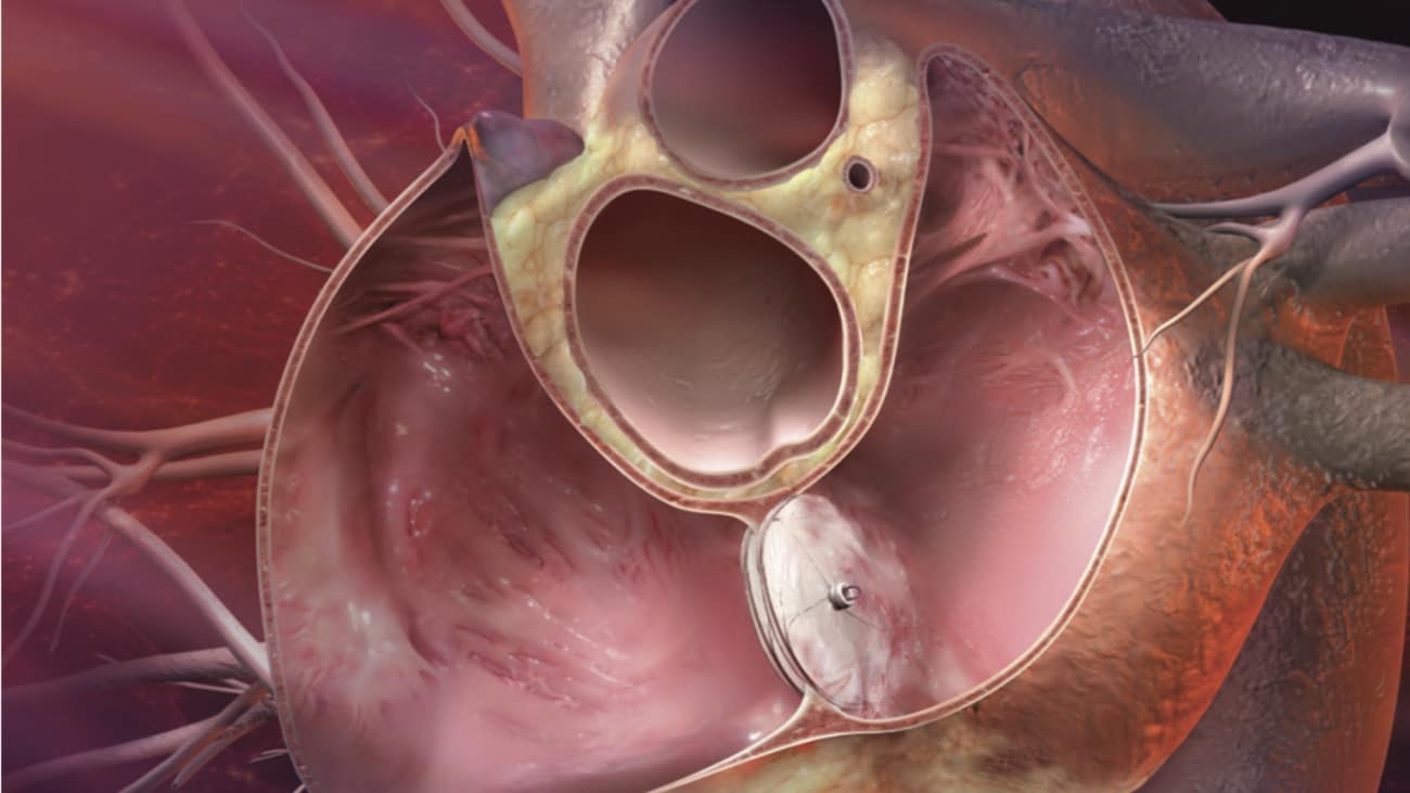 Closure of a patent foramen oval using a septal occluder.