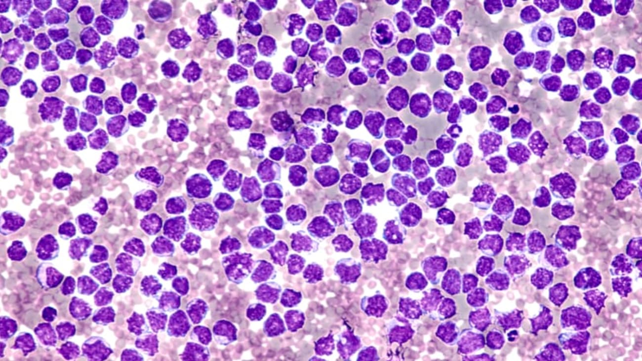 lymphoma pic