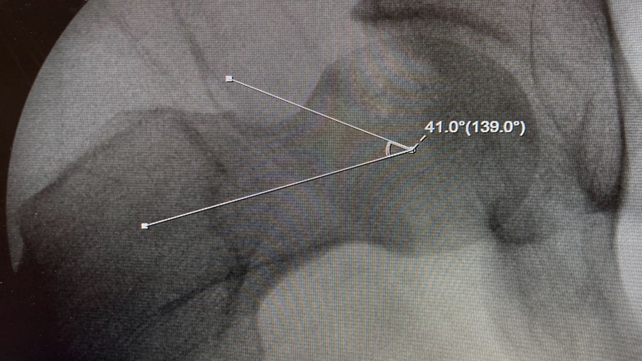 Figure 1: Femoroacetabular CAM impingement in a 27-year-old patient demonstrating a lateral center edge angle >69°; normal alpha angle is <50°.