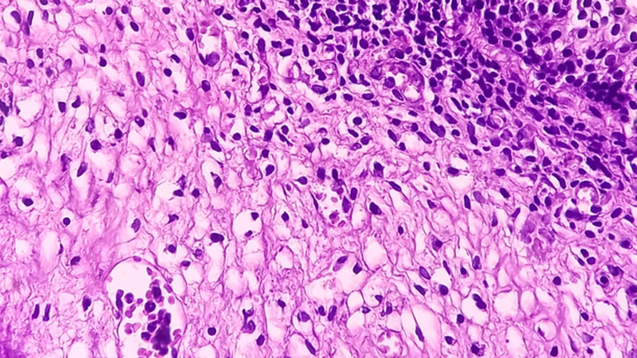 bladder cancer