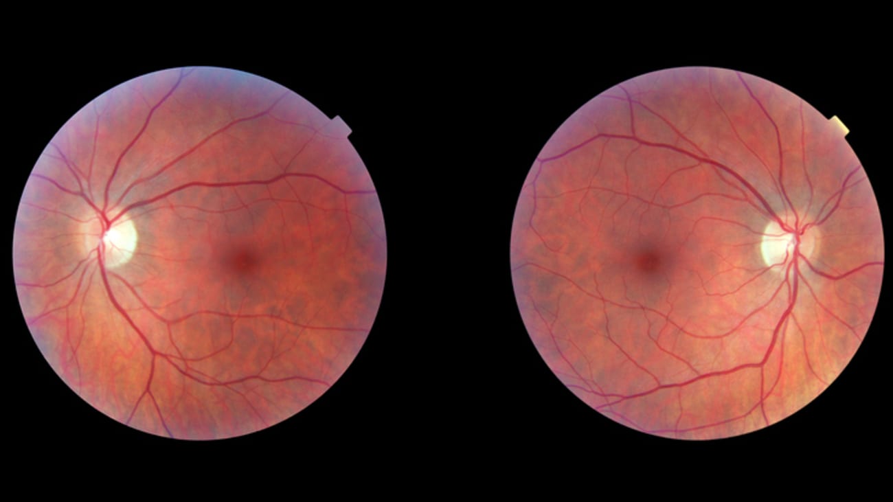 optic nerve
