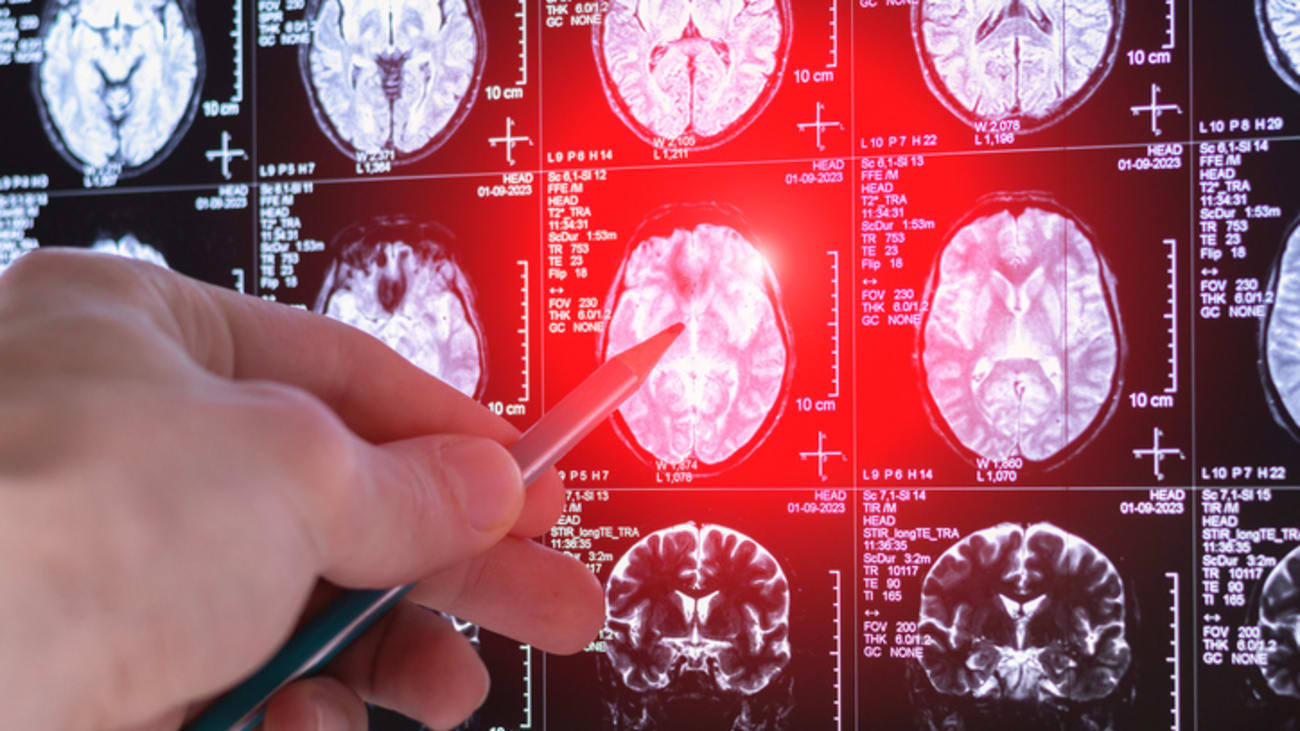 brain tumor