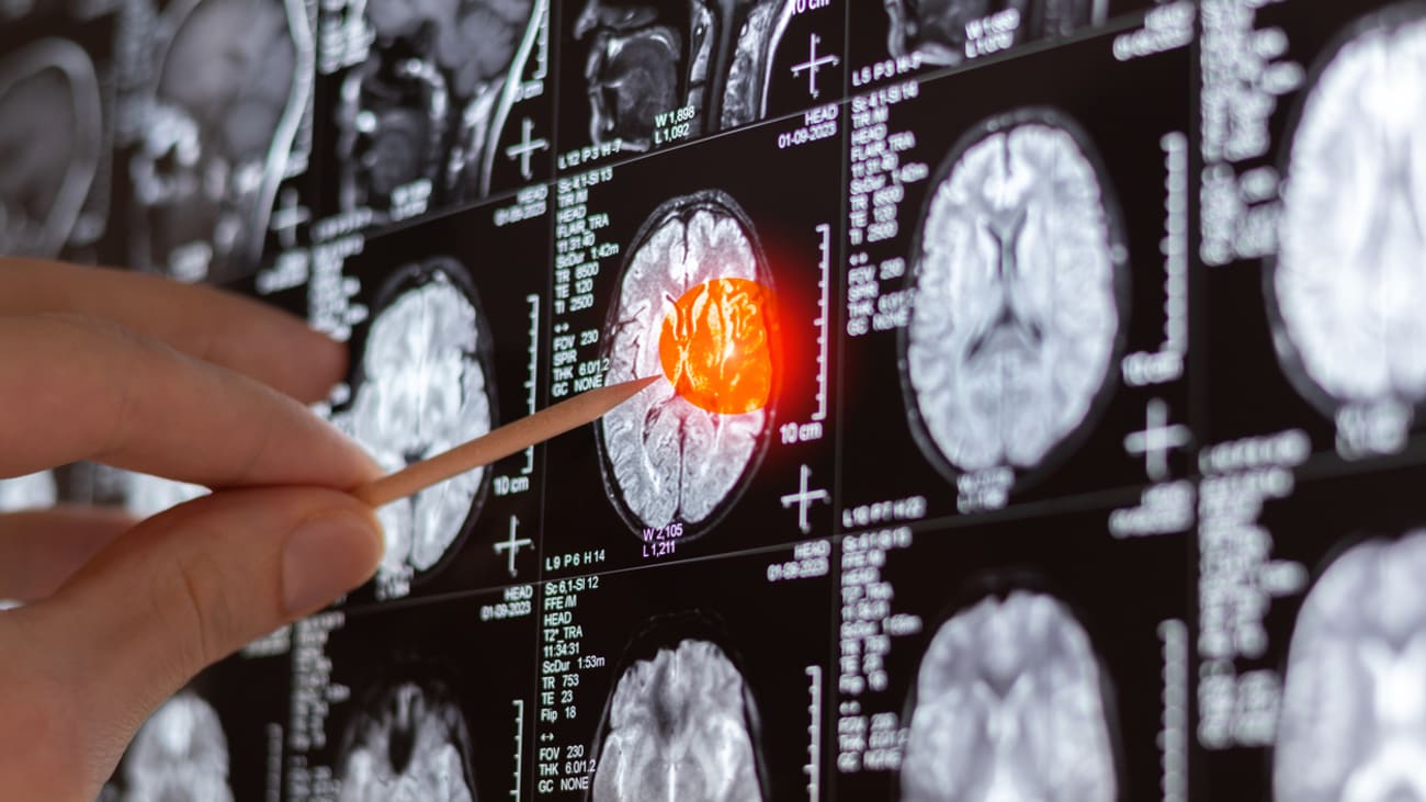 brain tumor