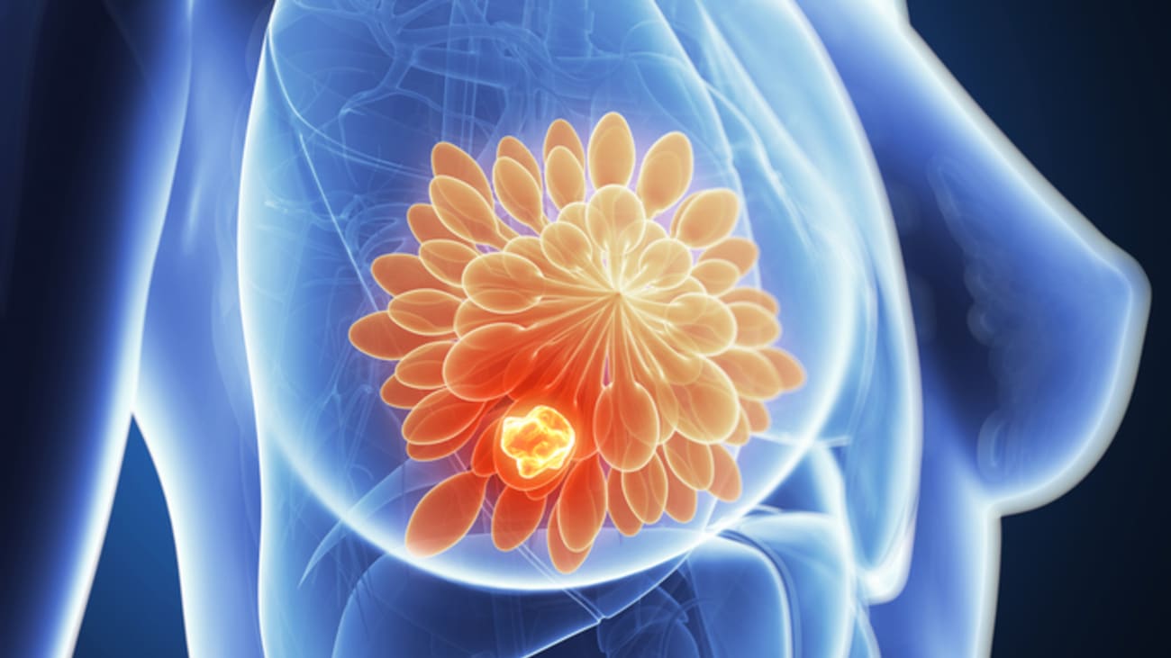 breast tumor