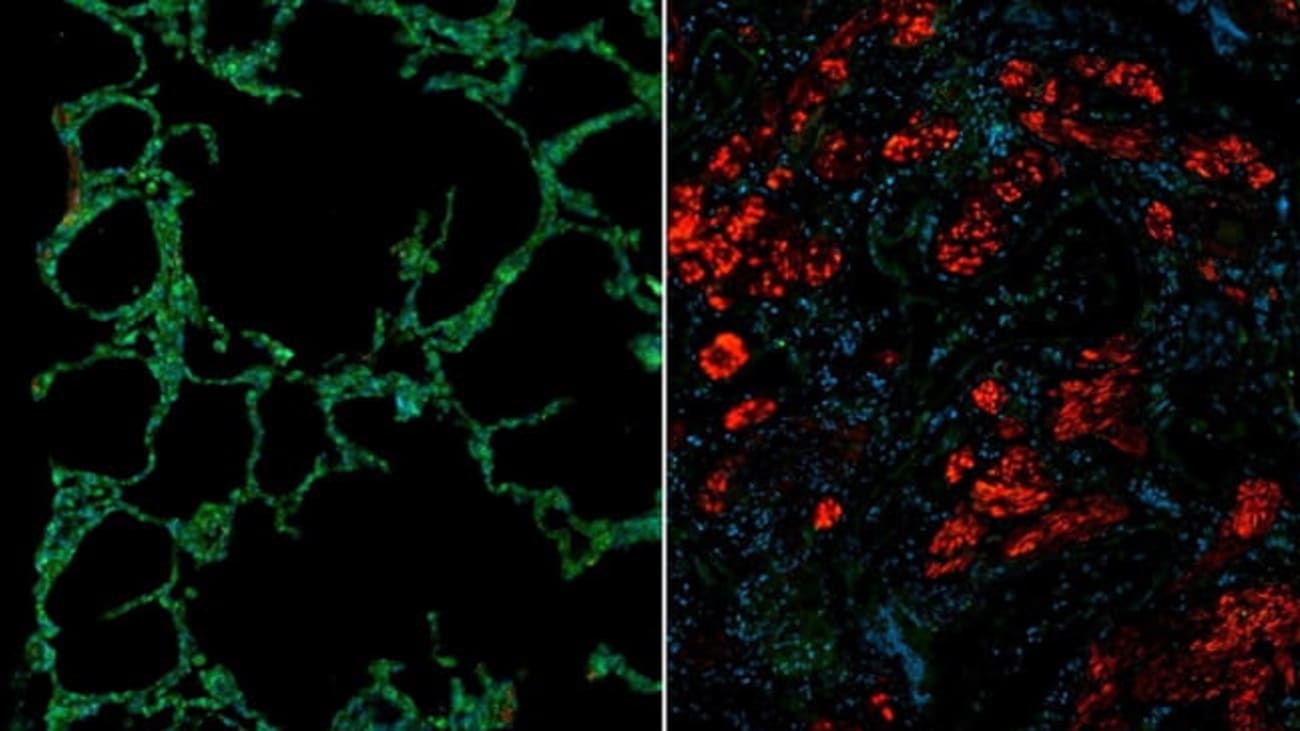 Immunofluorescence images showing healthy (left) and scleroderma (right) lungs. The scleroderma lung shows reduced levels of Cathepsin L (green) and increased levels of fibroblast activation marker (red).