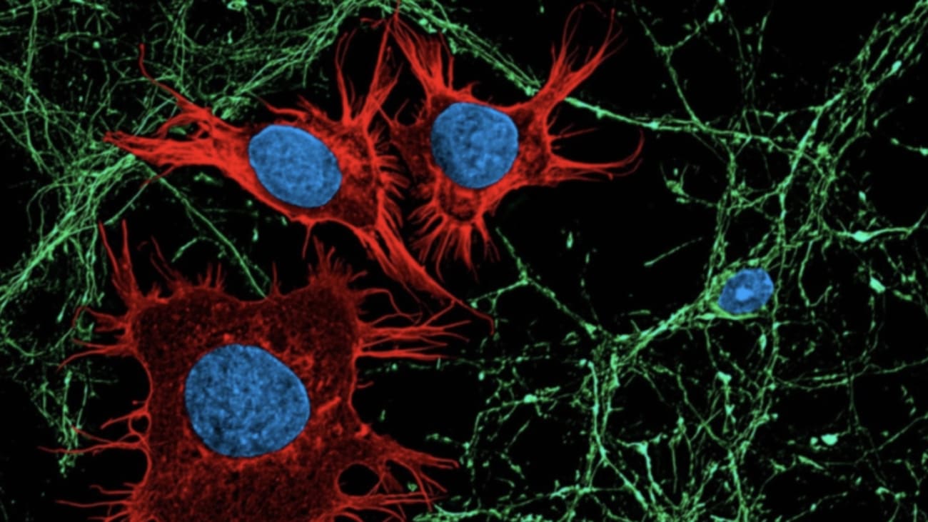 The image depicts neurons (green) in co-culture with medulloblastoma cells (red). Phenotypically, two contrasting cell types – the former normal and quiescent, while the latter cancerous and proliferating. Martirosian et al., through the perspective of cancer neuroscience, now provide evidence that rare cells in this pediatric brain tumor masquerade like quiescent neurons and exploit a neurotransmitter metabolic pathway to survive in the cerebrospinal fluid and promote leptomeningeal metastases. (Image/Vahan Martirosian, Josh Neman)