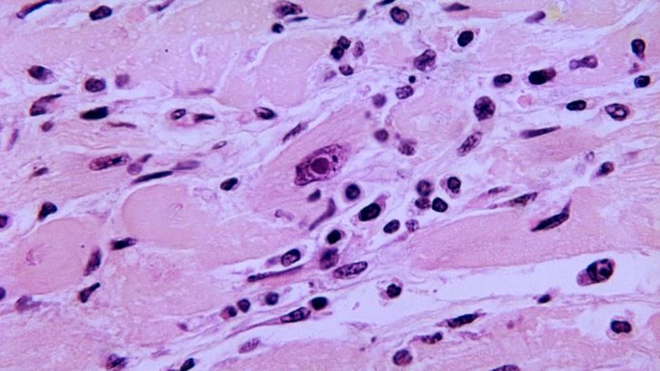Myocarditis This photomicrograph of a section of myocardial tissue revealed the presence of an intranuclear inclusion body, which was biopsied from a patient with a case of diphtheria-related myocarditis that was caused by the bacterium, Corynebacterium diphtheriae.