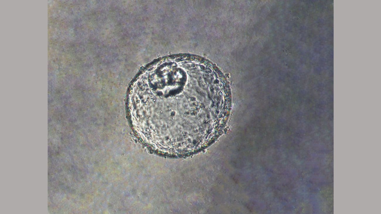 Image of human gastroesophageal junction-derived organoid, modified by dual-knockout of key tumor suppressor genes (TP53/CDKN2A) using CRISPR/Cas9 gene editing technology, which caused cells to become more cancerous. Photo courtesy of Stephen Meltzer, M.D.