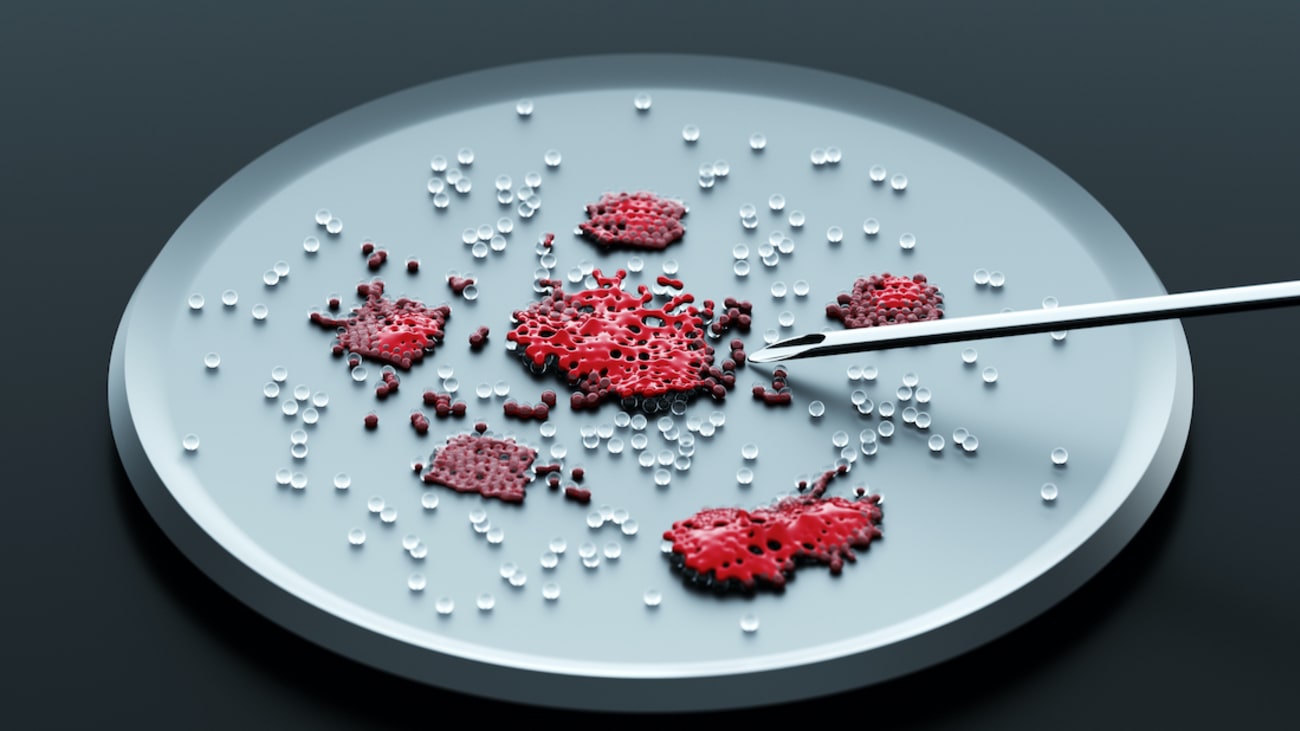 petri-dish-melanoma cells-header.jpg A 3D rendering shows a petri dish containing melanoma cancer cells at the tip of a needle. In their search for genes that provide tumor resistance, UT Southwestern researchers focused on a gene called H2-Aa, finding that mice carrying two mutated copies of the gene, causing them to lack the H2-Aa protein, often showed no tumor growth after exposure to melanoma cells. (Photo credit: Getty Images)