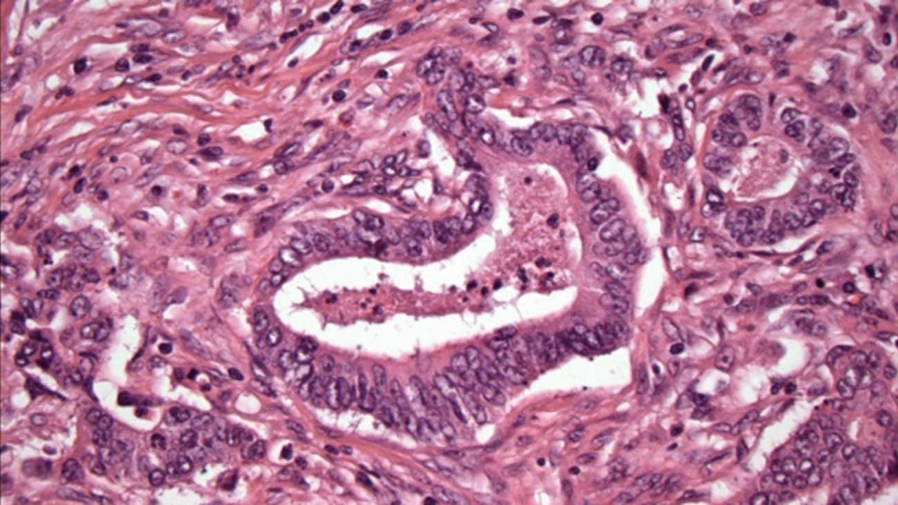 An image of colon cancer, with cancer cells forming circled structures. Photographed by Shuji Ogino, MD, PhD.