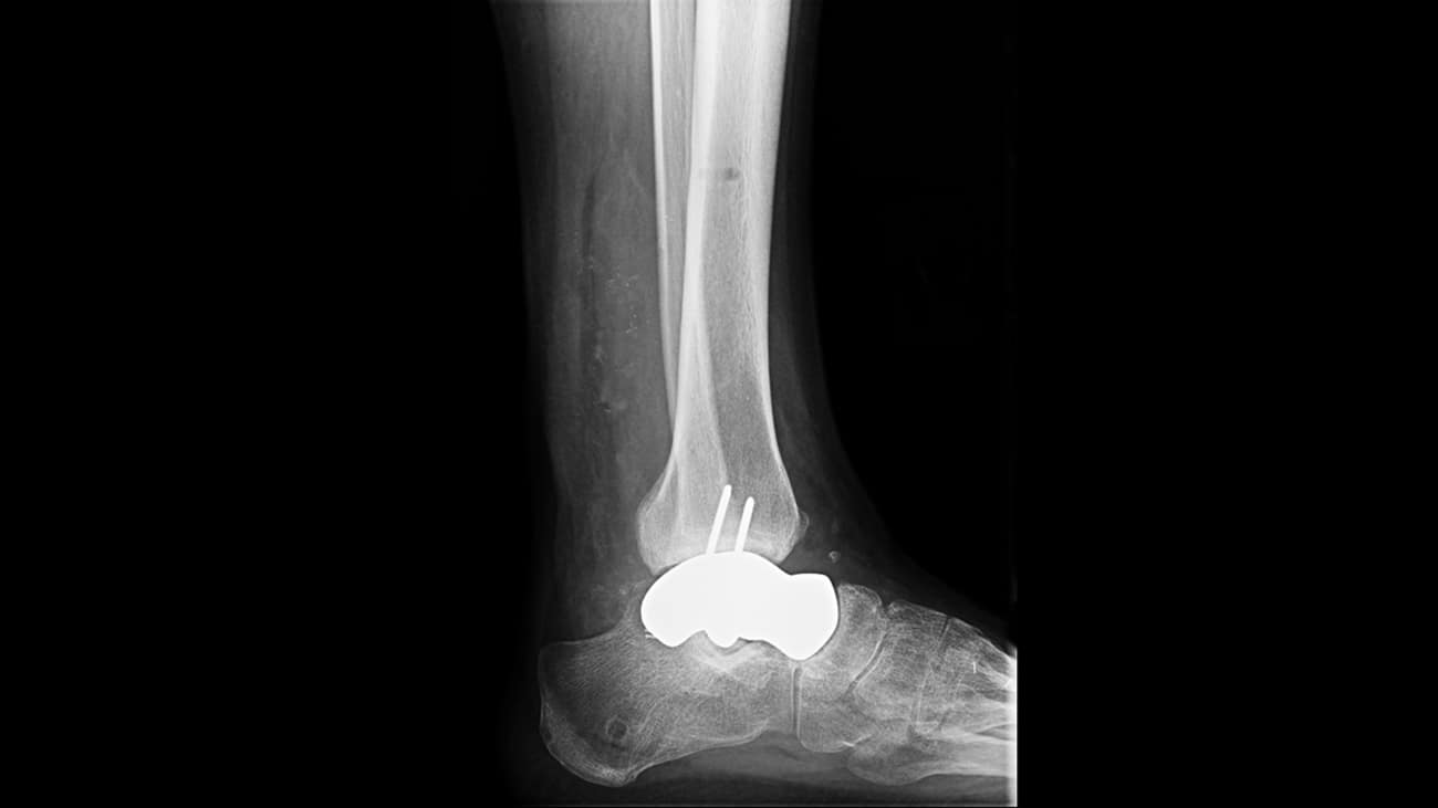 Figure 1: One year lateral view of a prosthetic total talar replacement in a 27-year-old patient who experienced avascular necrosis following a nonunited fracture of the talus