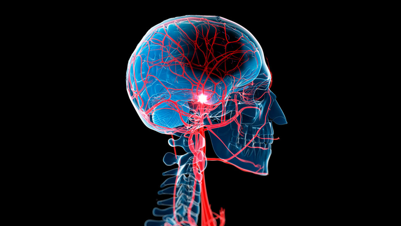 stroke