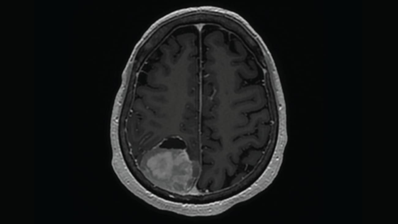 Meningioma MRI scan by Raleigh Lab